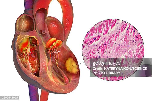 transmural myocardial infarction, illustration and light micrograph - light micrograph stock illustrations