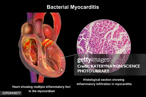Bacterial myocarditis, illustration and light micrograph Bacterial myocarditis, illustration and light micrograph