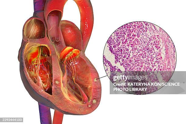 bacterial myocarditis, illustration and light micrograph - light micrograph stock illustrations