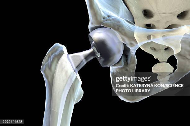 bipolar hemiarthroplasty prosthesis, illustration - hip replacement stock illustrations