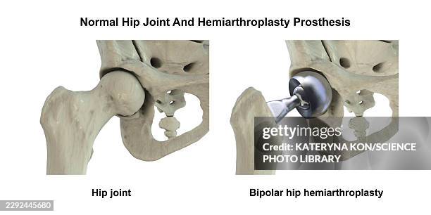 bipolar hemiarthroplasty prosthesis, illustration - comparing two things stock illustrations