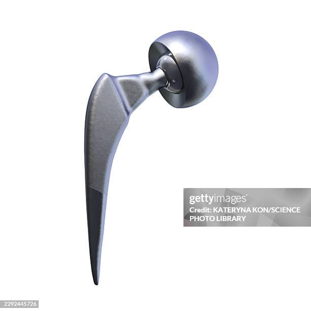 bipolar hemiarthroplasty prosthesis, illustration - hip replacement stock illustrations