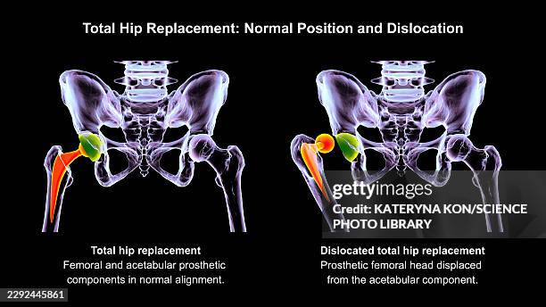 posterior dislocation of total hip replacement, illustration - total hip replacement stock illustrations