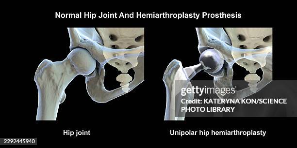 normal hip joint and unipolar hip prosthesis, illustration - hip replacement stock illustrations