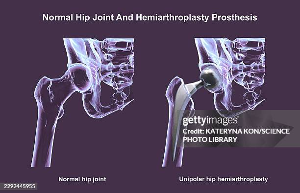 normal hip joint and unipolar hip prosthesis, illustration - hip replacement stock illustrations