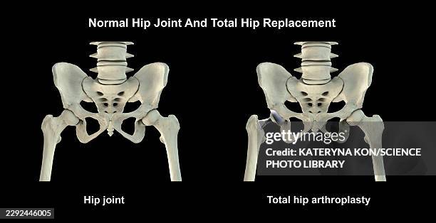 normal hip joint and total hip replacement, illustration - hip joint replacement stock illustrations