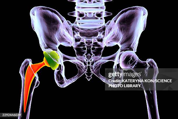 total hip replacement prosthesis, illustration - hip replacement stock illustrations