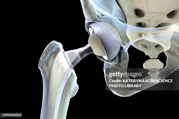 total hip replacement prosthesis, illustration - hip replacement stock illustrations