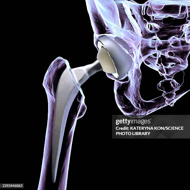 total hip replacement prosthesis, illustration - hip replacement stock illustrations