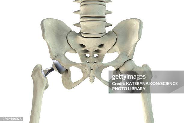 total hip replacement prosthesis, illustration - hip replacement stock illustrations