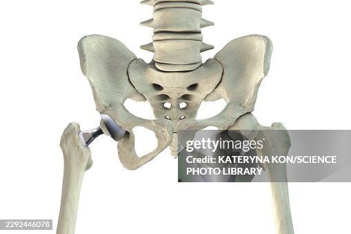 Total hip replacement prosthesis, illustration Total hip replacement prosthesis, illustration