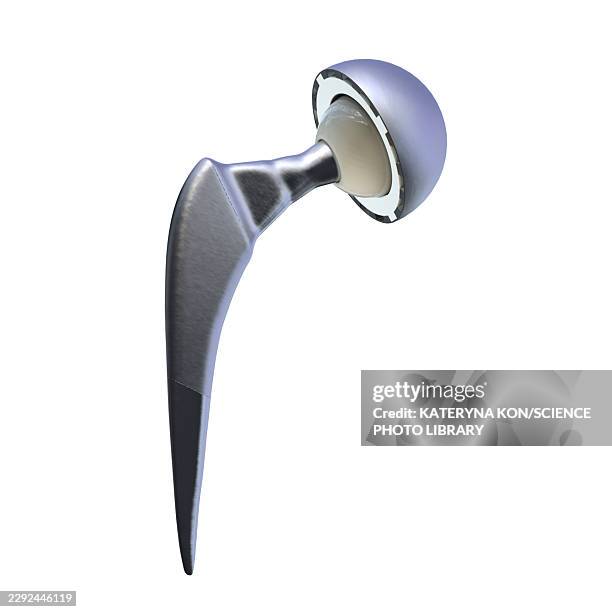 total hip replacement prosthesis, illustration - hip replacement stock illustrations