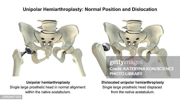 bipolar hip hemiarthroplasty prosthesis, illustration - hip replacement stock illustrations