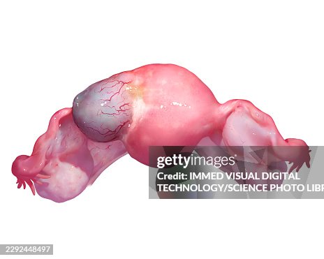 Ectopic pregnancy, illustration Ectopic pregnancy, illustration