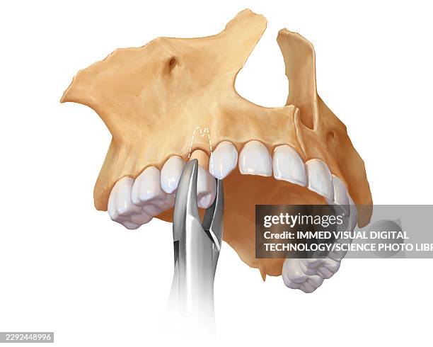 upper premolar extraction, illustration - tooth extraction stock illustrations