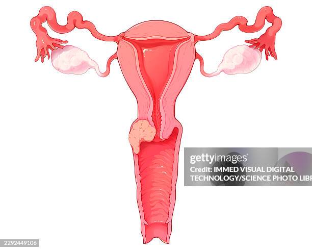 cervical cancer stage iia2, illustration - cervical screening stock illustrations