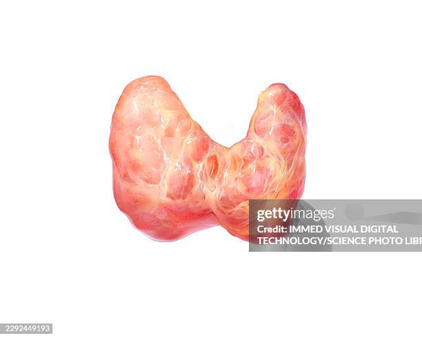 overactive enlarged thyroid, illustration - schilddrüsenüberfunktion stock-grafiken, -clipart, -cartoons und -symbole