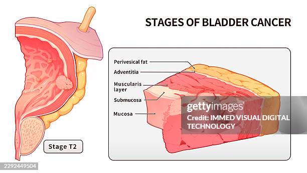 bladder cancer stage t2, illustration - bladder cancer stock illustrations