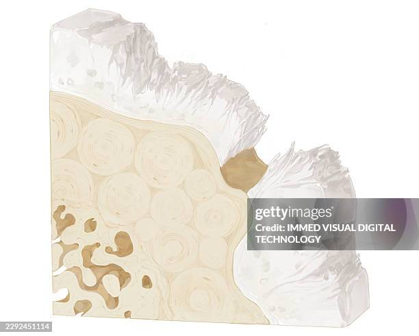 moderate osteoarthritis, illustration - eroded stock illustrations