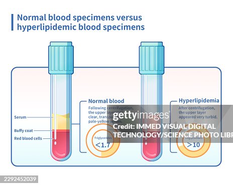 Hyperlipidaemia blood sample comparison, illustration Hyperlipidaemia blood sample comparison, illustration