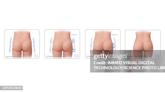 Square buttock augmentation steps, illustration Square buttock augmentation steps, illustration