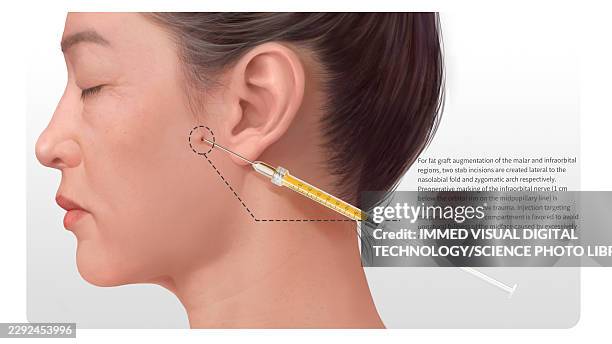 midface fat grafting injection sites, illustration - standard operating procedures stock illustrations