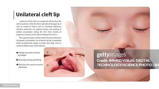 unilateral cleft lip nasal deformity, illustration - plastic surgery stock illustrations