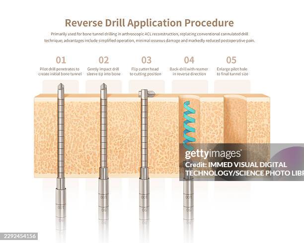 retrograde drill usage, illustration - laparoscopic surgery stock illustrations