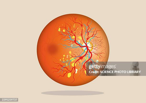 diabetic retinopathy, illustration - colour blind test stock illustrations