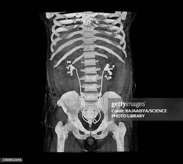 urinary system stent, x-ray - urinary catheter stock pictures, royalty-free photos & images