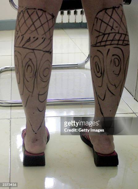 Cosmetic surgical marks are seen on the legs of Lucy Hao ahead of a liposuction operation in a hospital on August 6, 2003 in Beijing, China. Hao a...
