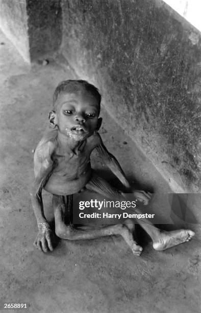 Starving Ibo child in Nigeria, a casualty of the Biafran War.