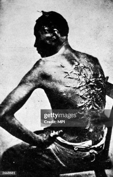 Gordon, also known as "Whipped Peter", a former enslaved man, shows his scarred back at a medical examination, Baton Rouge, Louisiana, 2nd April...