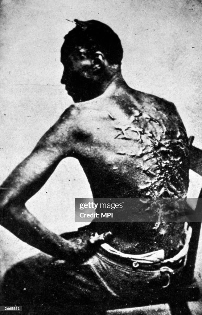 Rear View of Former Enslaved Man Revealing Scars at Medical Inspection