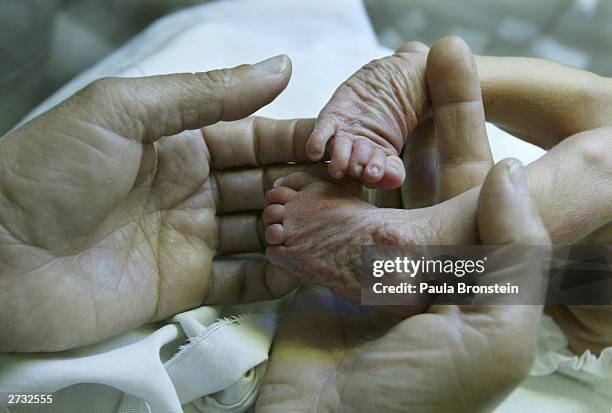 Born Defects Baby Birth Defects Photos and Premium High Res Pictures - Getty Images