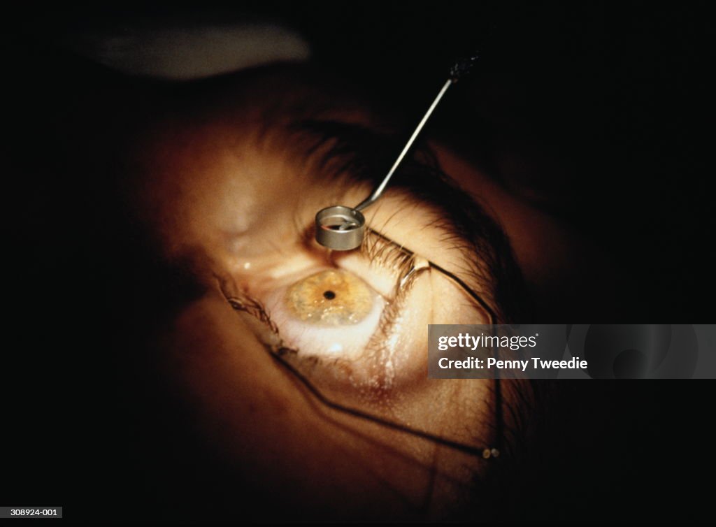 Myopic eye of patient receiving laser surgery,close-up