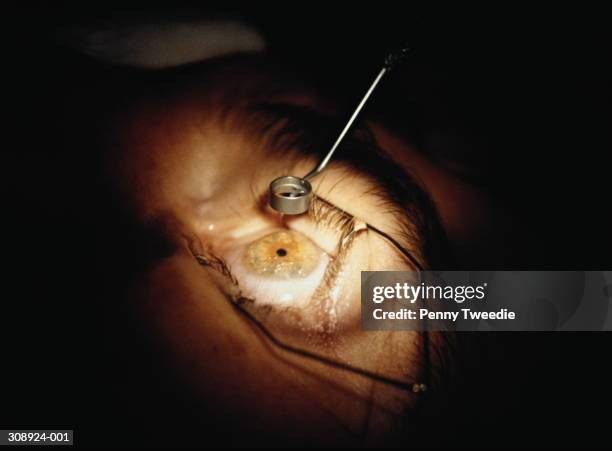 myopic eye of patient receiving laser surgery,close-up - myopia stock pictures, royalty-free photos & images