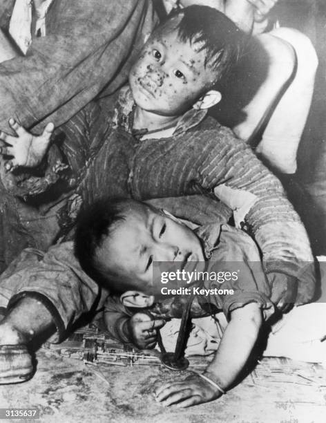 Two little Chinese boys infected with smallpox.