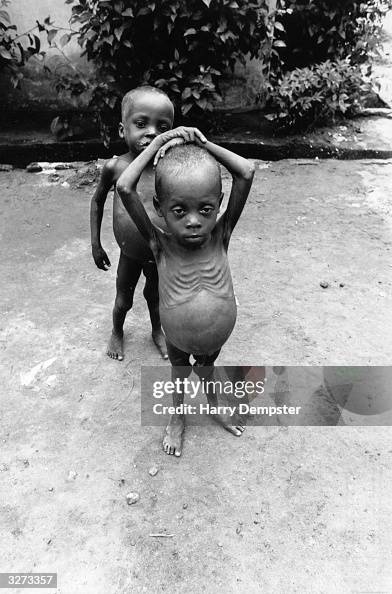 Starving Nigerian Children At The Nigar Hospital Port Harcourt starving-nigerian-children-at-the-nigar-hospital-port-harcourt