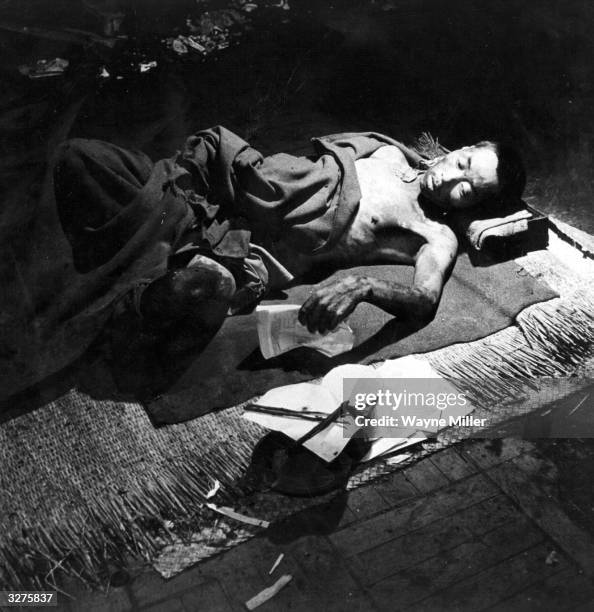 Victim of the atomic bomb blast over Hiroshima, in a makeshift hospital in a bank building.