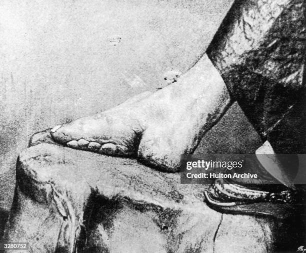 Close-up of the feet of an aristocratic Chinese woman, deformed by binding. Foot binding in China was abolished in 1902. Original Publication:...