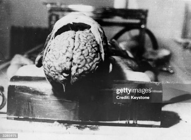An autopsy specimen of the brain of a Dachau concentration camp victim. Experiments were carried on the victims by first putting them in a...