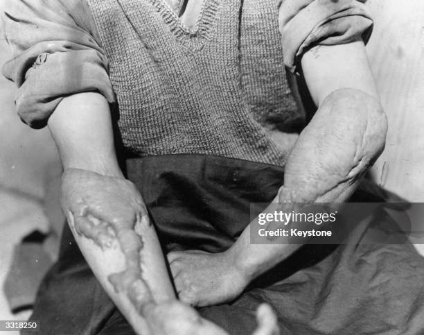 Victim of the American atomic bombing of Hiroshima, Japan, shows the burns on his arms.