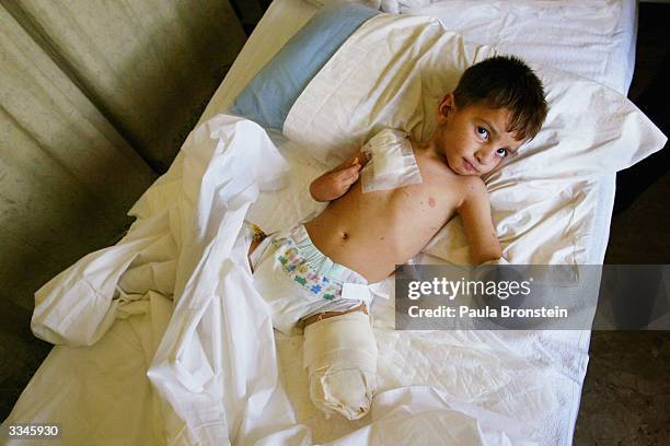 Ali Nassar Fadil, 4 years old, lies in a ward at the Italian Red Cross hospital, on April 13, 2004 after loosing his left arm and leg 5 days ago from...