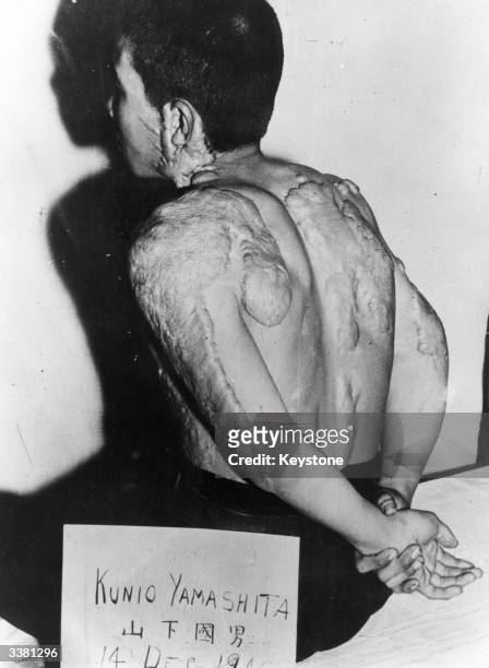 Kunio Yamashita displaying the injuries he suffered as a result of the atomic bomb that was dropped on Hiroshima on the 6th August 1945.