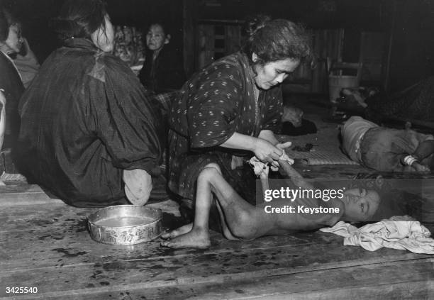 Severely malnourished girl from Okinawa is given a sponge bath in a refugee camp on the island, which is part of south-west Japan.