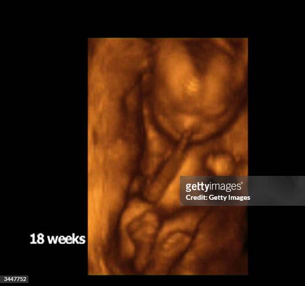 In this handout from Channel 4, a screen grab of a 18 week old baby is seen. Filmmaker Julia Black, who will air footage on April 20, 2004 of her...