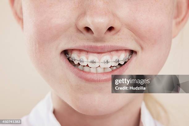 a smiling girl with braces on her teeth, close-up of mouth - apparecchio ortodontico foto e immagini stock