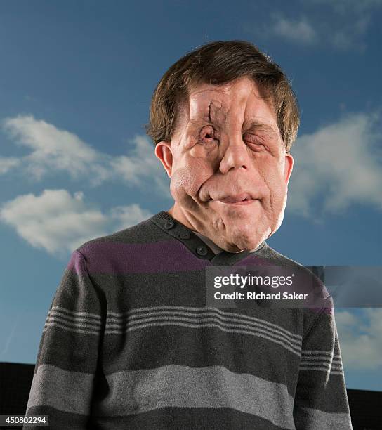 Researcher and actor Adam Pearson who has a genetic condition called neurofibromatosis, meaning the nerve tissue in his face grows very visible...