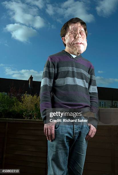 Researcher and actor Adam Pearson who has a genetic condition called neurofibromatosis, meaning the nerve tissue in his face grows very visible...